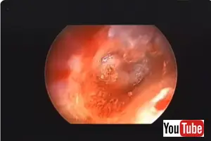 Mastoidectomy