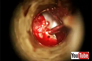 Stapedectomy