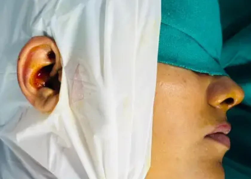 How Is Tympanoplasty Performed