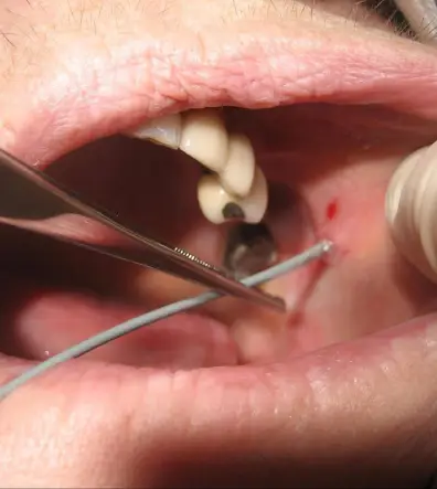 Sialendoscopy