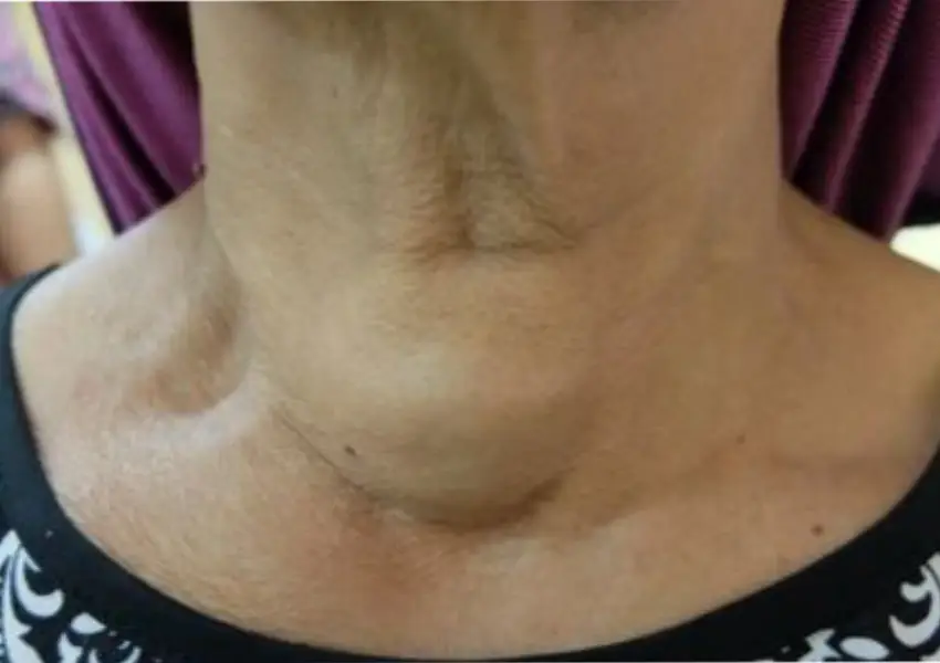 Signs You May Need Throat Surgery