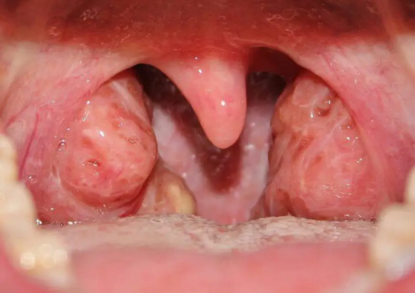What Does Throat Surgery Treat