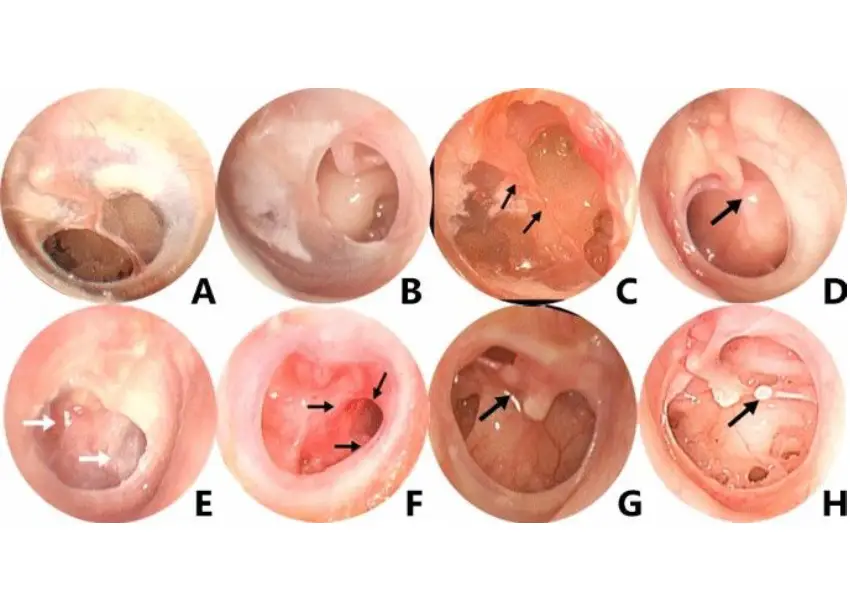 When Is Ear Surgery Needed