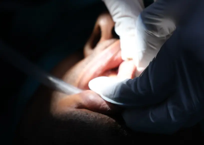 Benefits of Sialendoscopy